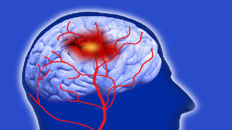دواء فعّال لعلاج الجلطة الدماغية